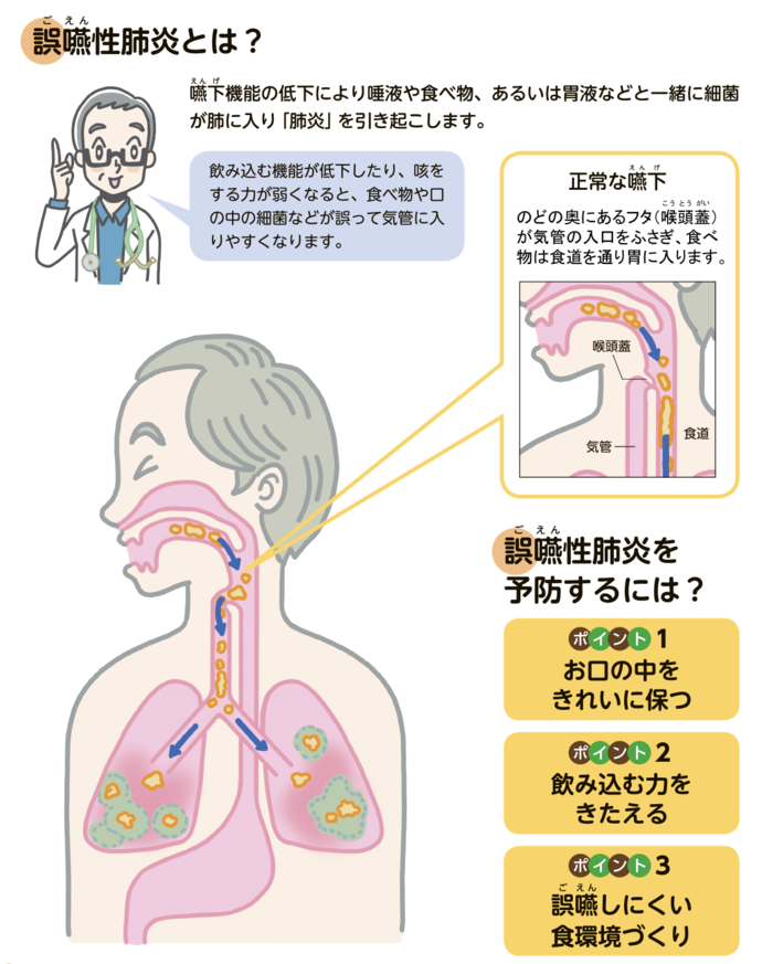 誤嚥性肺炎とは？嚥下機能の低下により唾液や食べ物、あるいは胃液などと一緒に細菌が肺に入り「肺炎」を引き起こします。飲み込む機能が低下したり、咳をする力が弱くなると、食べ物や口の中の細菌などが誤って気管に入りやすくなります。正常な嚥下、のどの奥にあるフタ（喉頭蓋）が気管の入口をふさぎ、食べ物は食道を通り胃に入ります。喉頭蓋、気管、食道、誤嚥性肺炎を予防するには？ポイント1お口の中をきれいに保つ、ポイント2飲み込む力をきたえる、ポイント3誤嚥しにくい食環境づくり