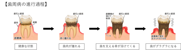 歯周病進行過程のイラスト